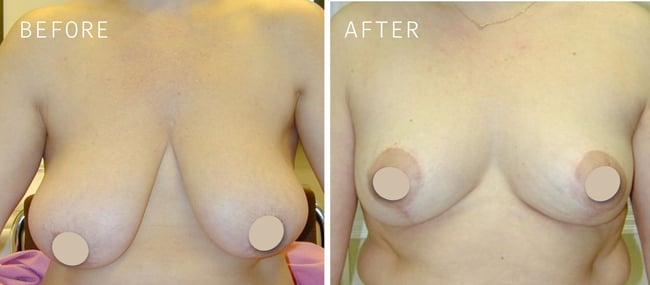 Before-after