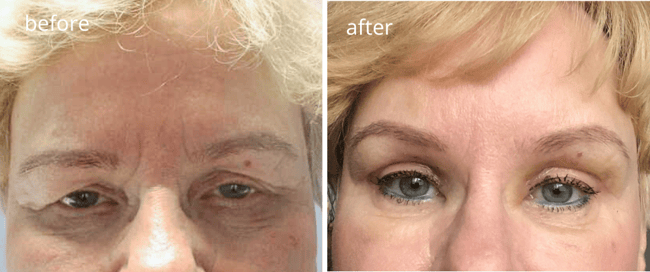 Endoskooppinen kulmiennosto Endoskooppinen kulmiennosto