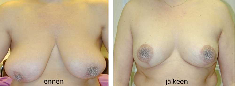Rintojen kohotus before and after kuva