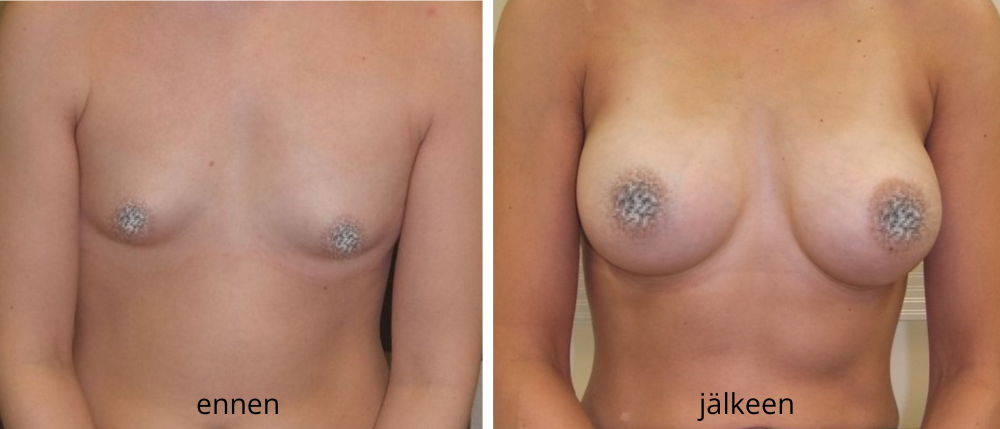Ennen ja jälkeen kuva rintojen endoskooppisesta suurennuksesta.