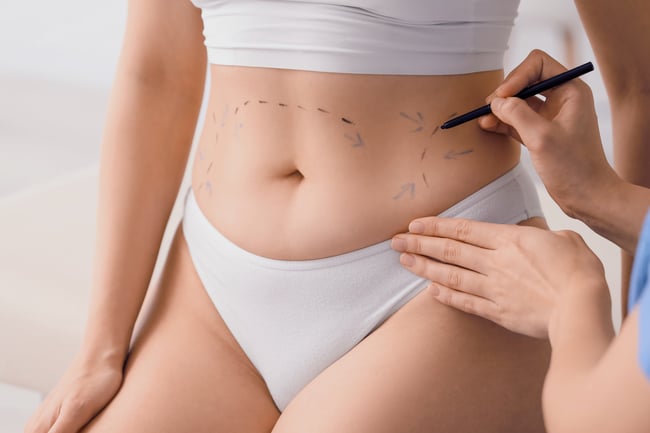 Kirurgi piirtää viivat vatsan toimenpiteeseen