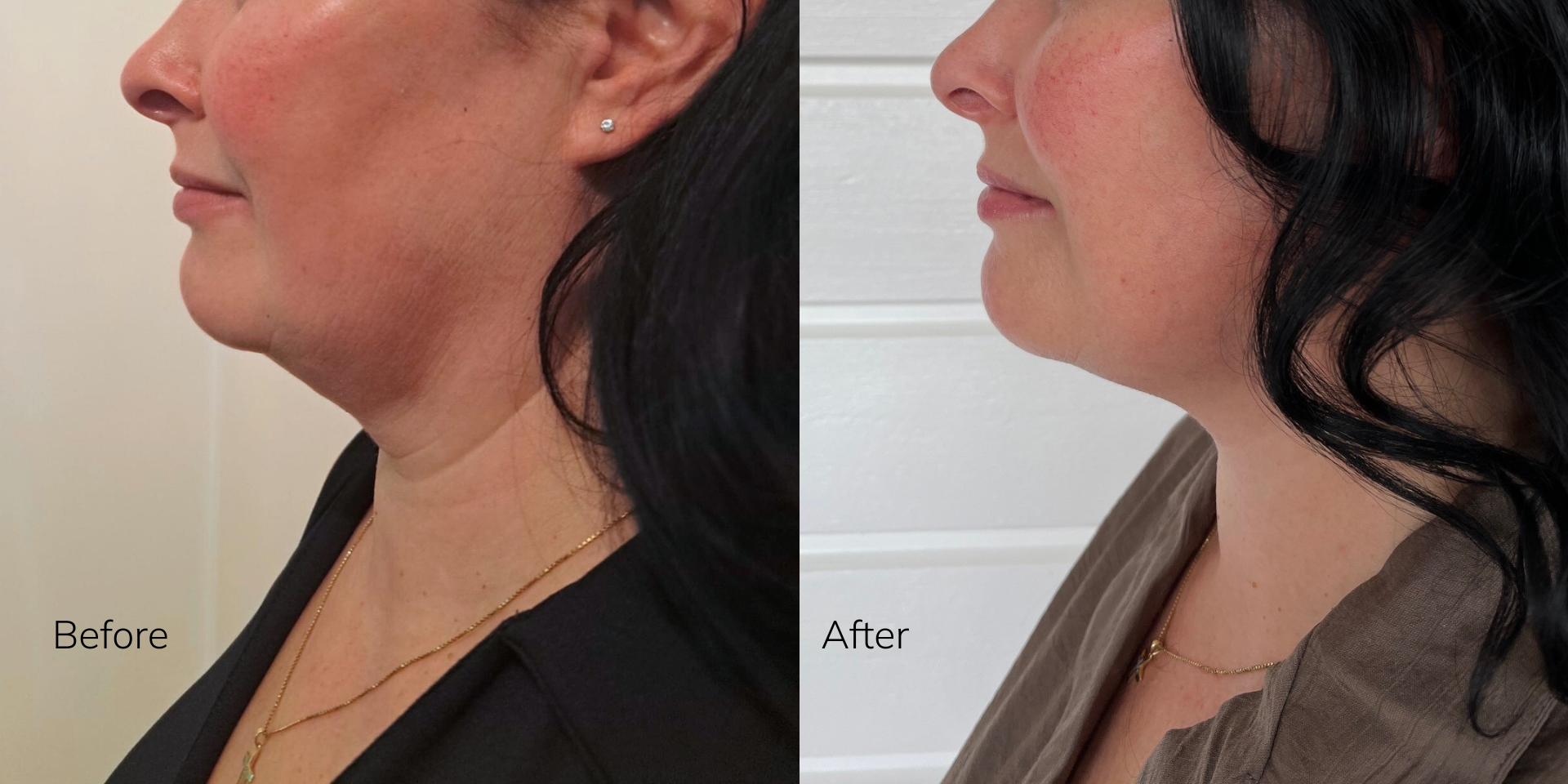 SMAS-lift before and after