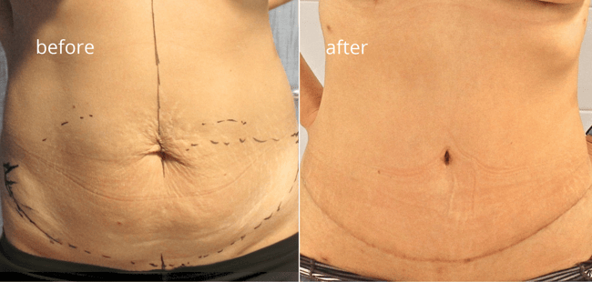 abdominoplastia before-after