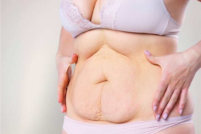 abdominolpastiaa tarvitseva vatsa