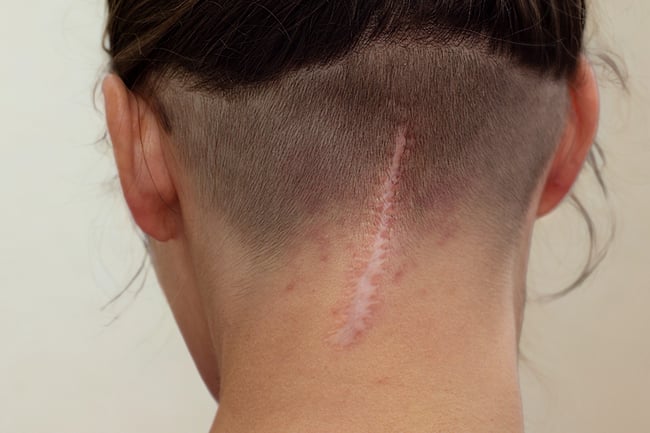 Arpia voidaan hoitaa monilla tavoin