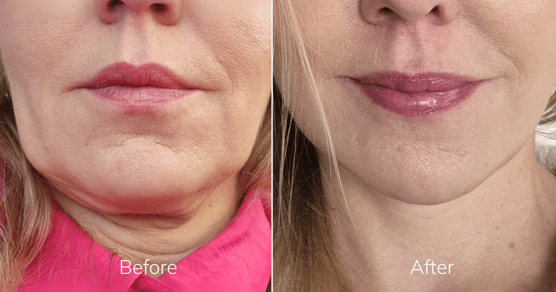 SMAS lift before and after