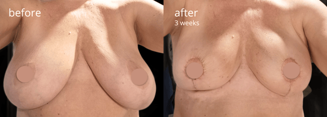 rintoejn pienennys before-after2