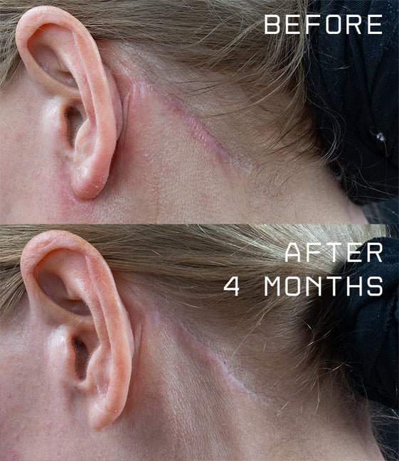 woman 51 scar before and after woman 51 scar before and after