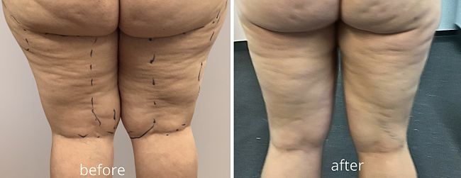 Before-after rasvaimu Before-after rasvaimu